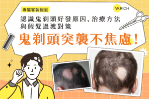 鬼剃頭突襲不焦慮！認識鬼剃頭好發原因、治療方法與假髮過度對策