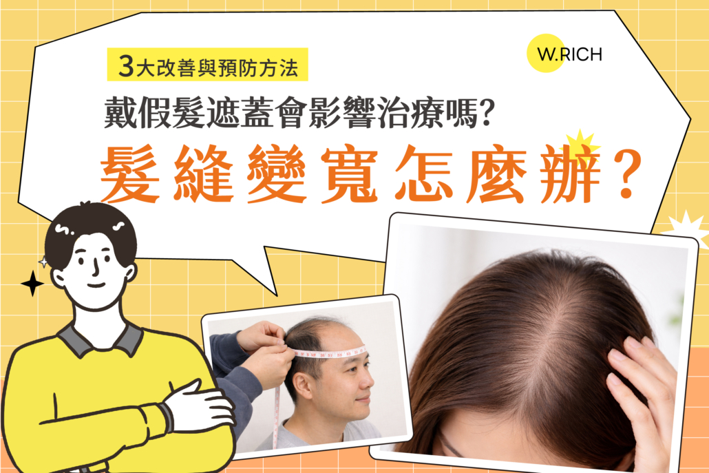 髮縫變寬怎麼辦?3大改善與預防方法,戴假髮遮蓋會影響治療嗎?